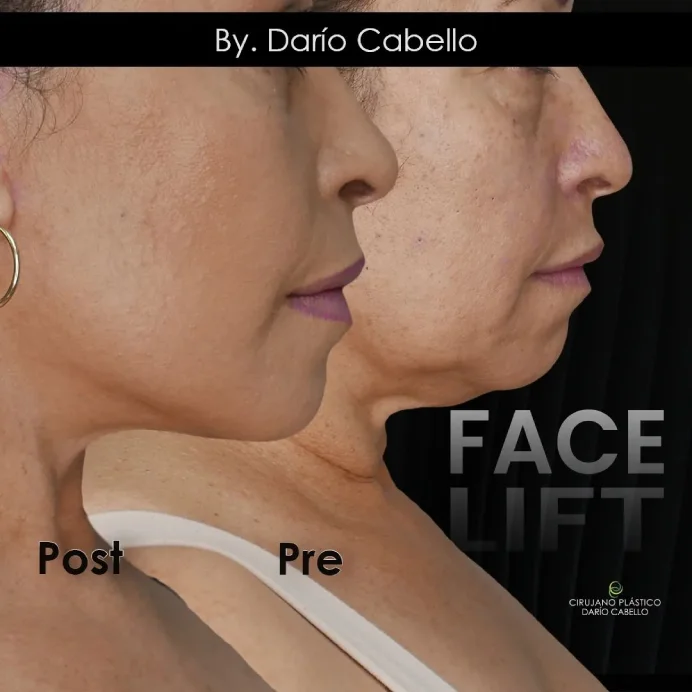 Case 4 Before and After