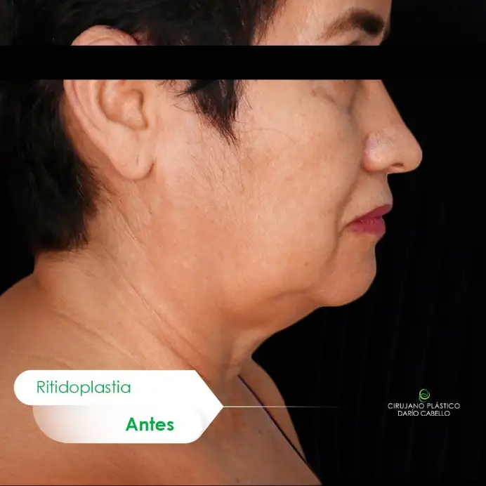 Case 9 Before and After