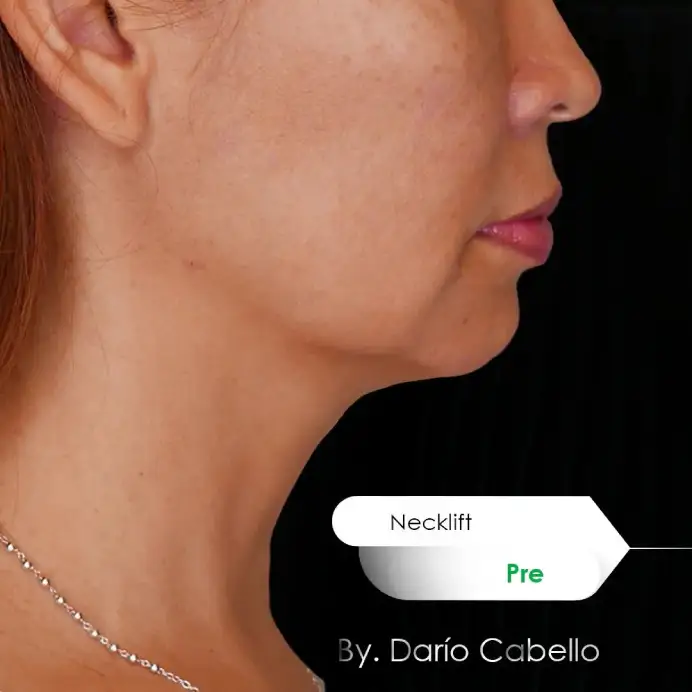 Case 13 Before and After