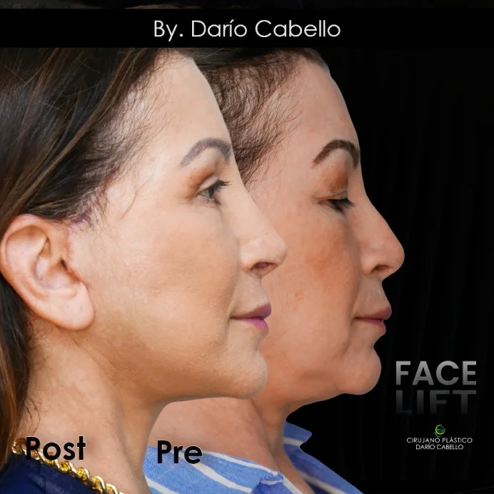 Case 9 Before and After