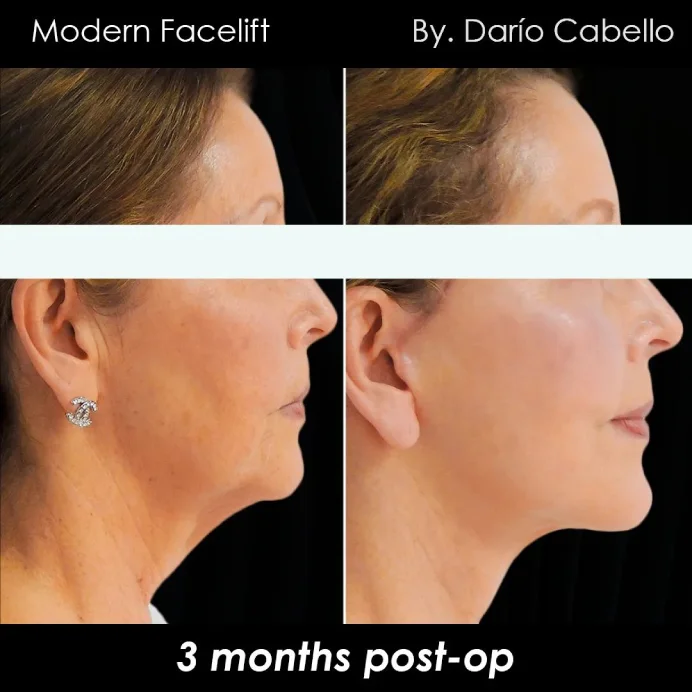 Case 10 Before and After