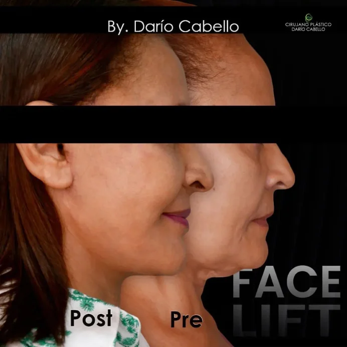 Case 11 Before and After