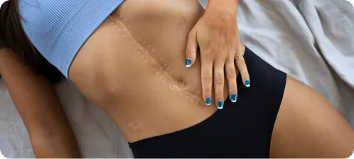 Scars