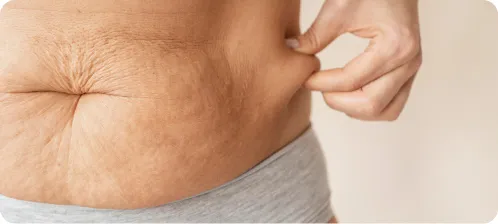 Stretch Marks