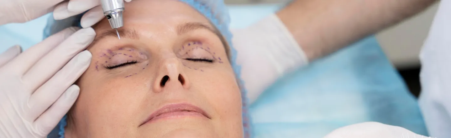 imagen principal de Blefaroplastia