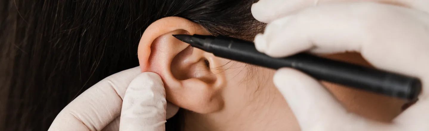 imagen principal de Otoplastia