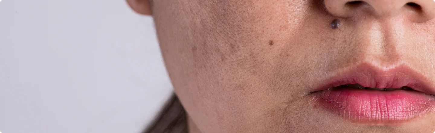 imagen principal de Manchas faciales