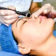 Microdermabrasion